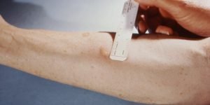 Mantoux, la prueba de la tuberculosis más utilizada