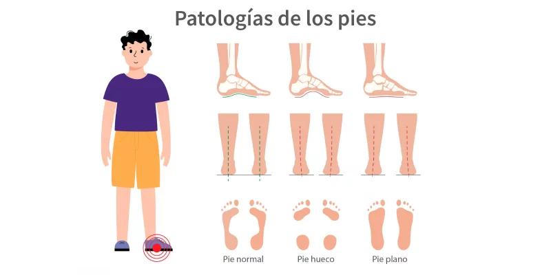 infografía sobre los tipos de pie que existen
